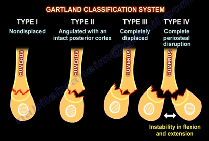 gartland classification